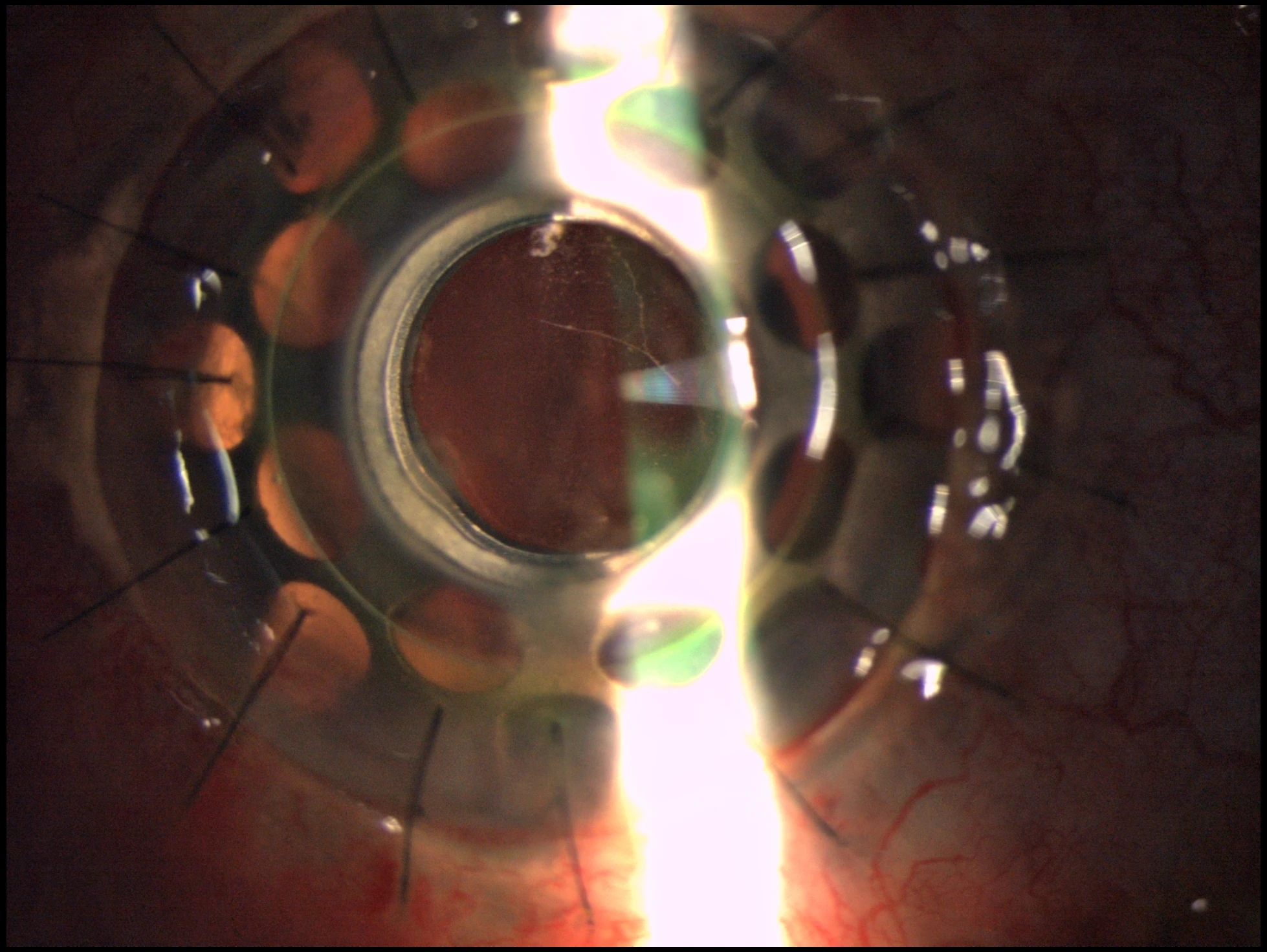 Boston KPro Type I slit-lamp detail
